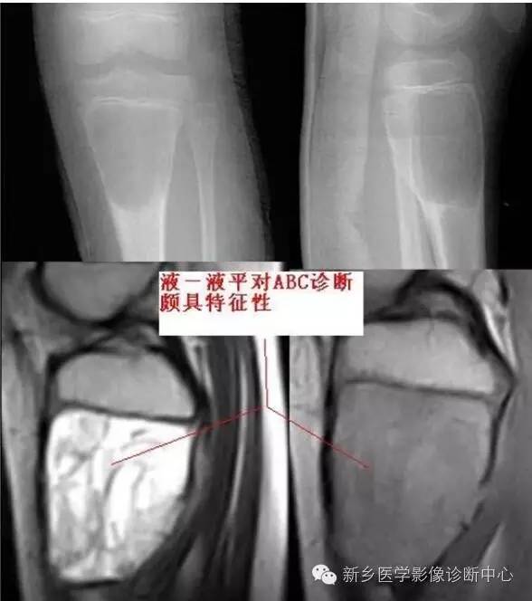 长骨膨胀性病变,长骨偏心性膨胀性病变