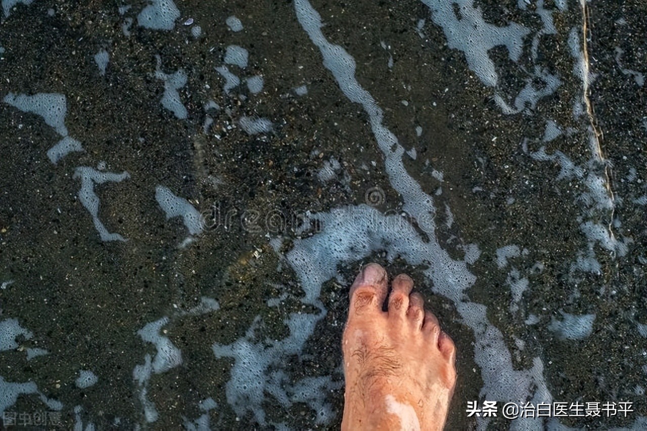 白癜风为什么会一边治疗还一边在发展，这正常吗？