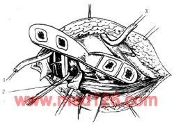 扁平足发病机制,扁平足诊断标准示意图