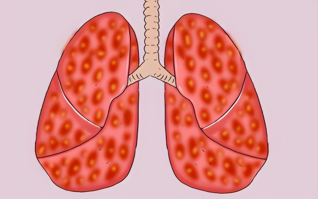 肺癌为什么一发现就是晚期腰疼,肺癌晚期患者脚老是麻的能活多久