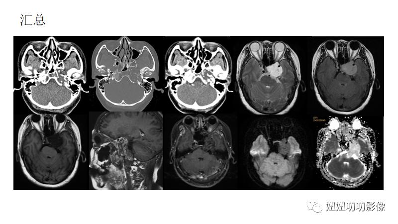 软骨肉瘤mri,骨肉瘤ctmr表现