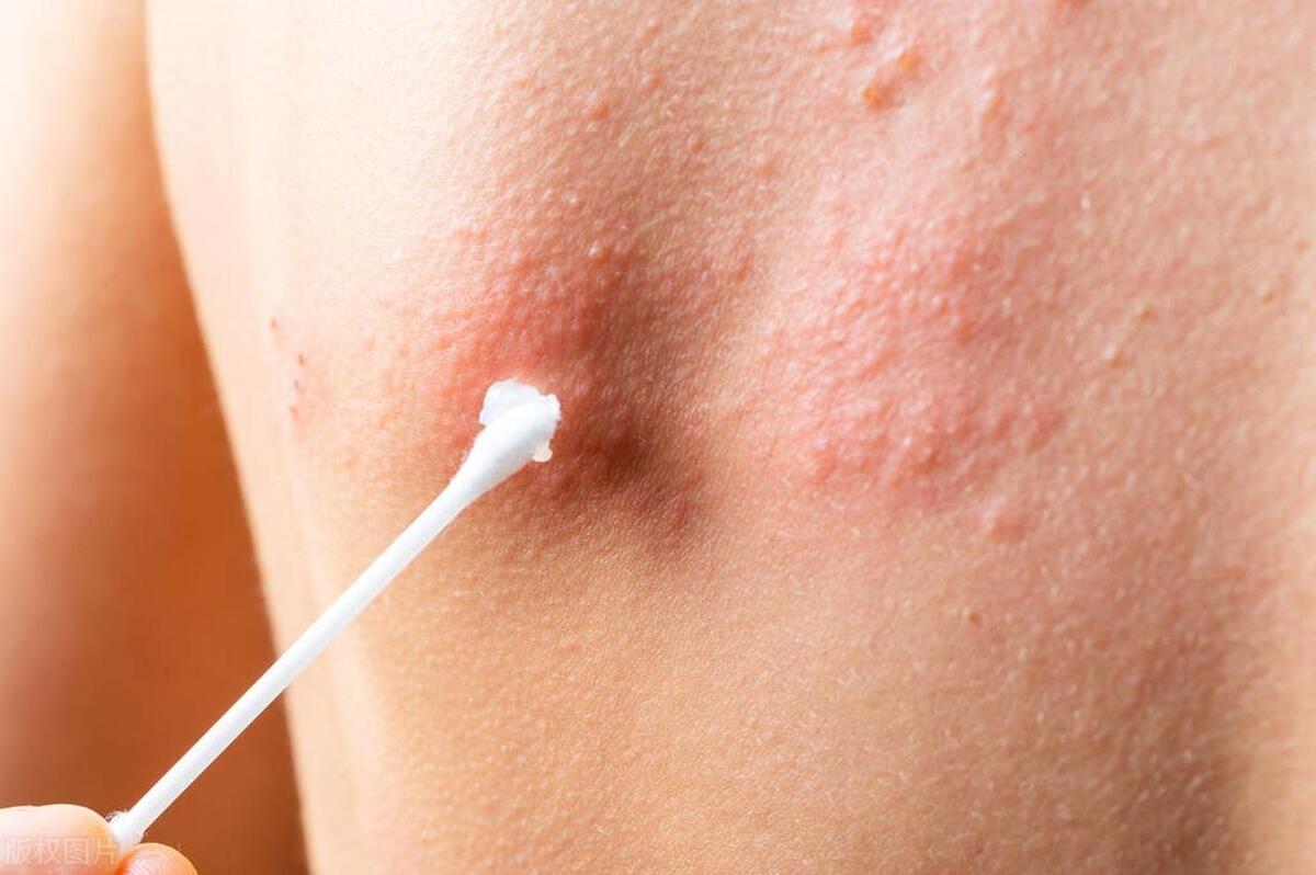 70岁老人查出有梅毒,老人晚期潜伏梅毒