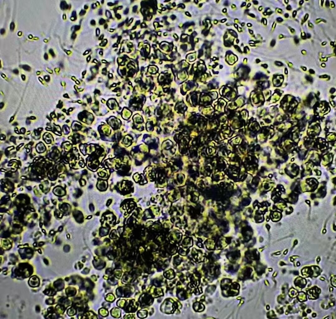 前列腺常规检查报告单正常,前列腺核磁共振报告单怎么解读