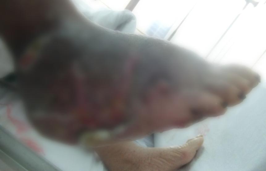 男子被烧伤医生拿来10万条虫,21岁小伙被严重烧伤