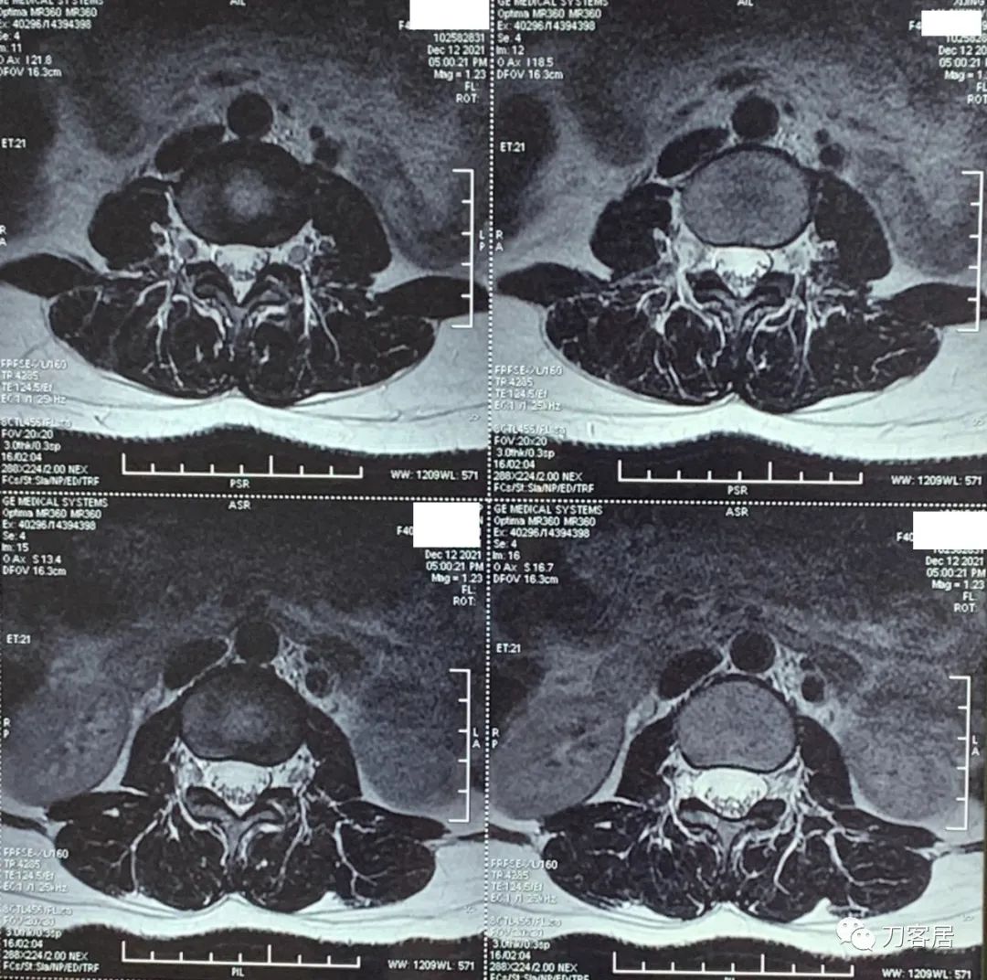 50多岁女性剧烈腰痛,40岁女人腰痛是什么原因引起的