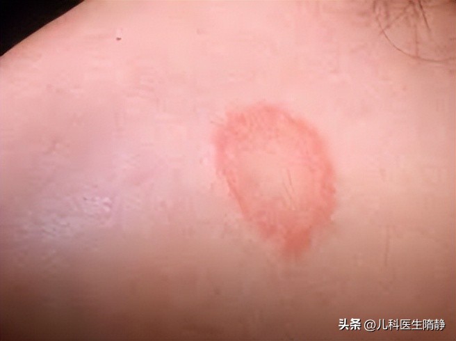 家有湿疹宝宝的看过来,家有过敏宝宝终于好了说说