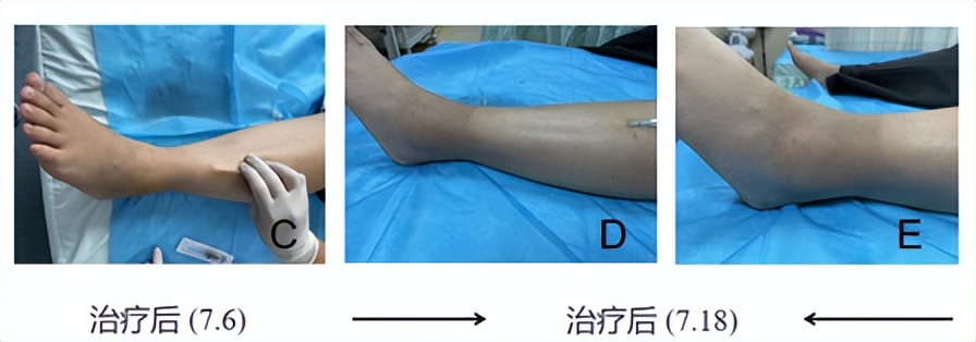 崴脚、富贵包、腰痛这些都可以去一个科一针搞定