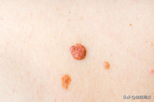 脖子上的小肉球多怎么回事,脖子上的小肉疙瘩是什么原因