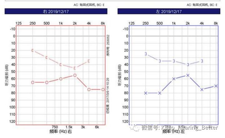 南昌大学二附院耳喉科,耳膜硬化症是什么样子