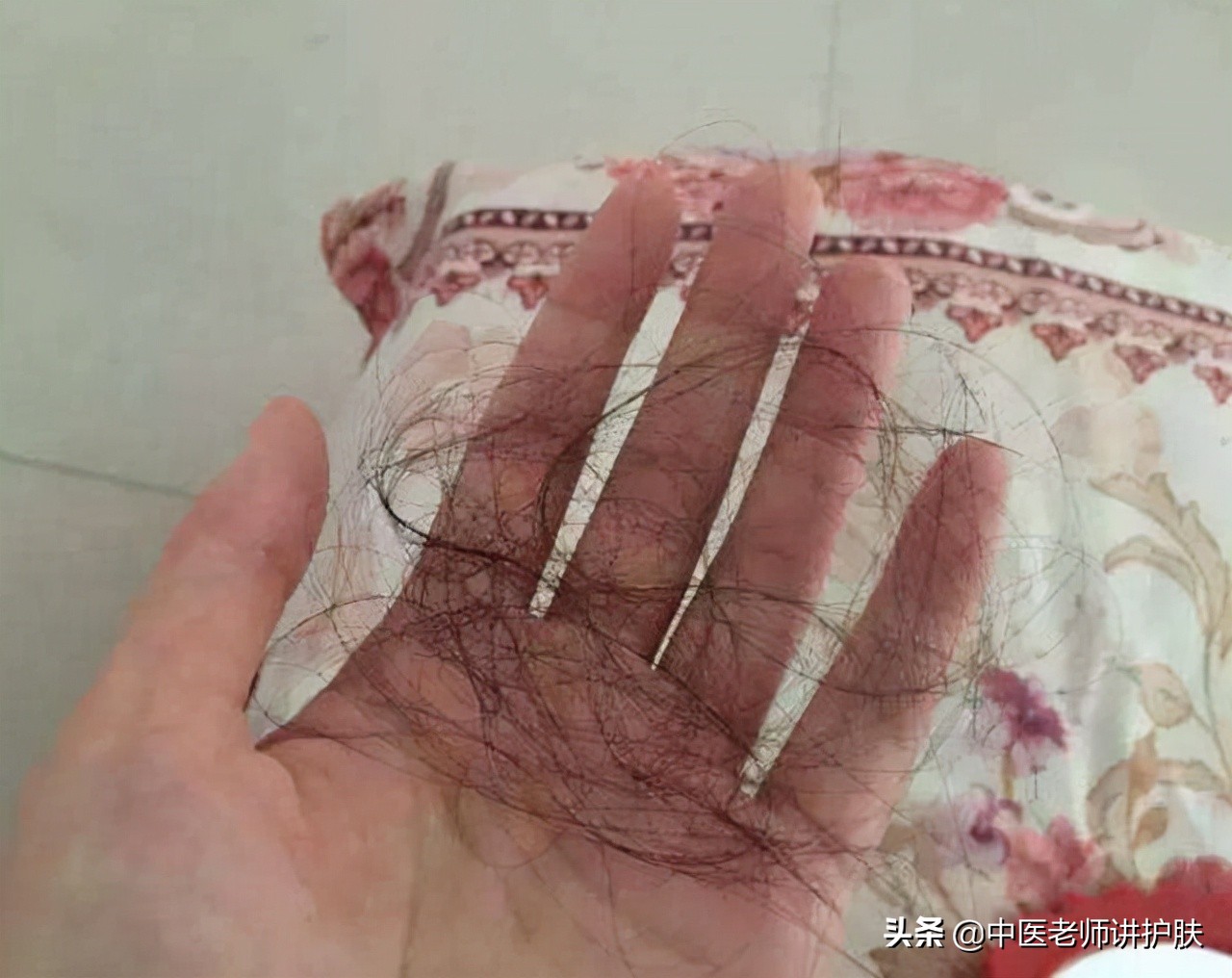 脂溢性脱发西医和中医的解释原理,中医白发和脱发是什么原因造成的