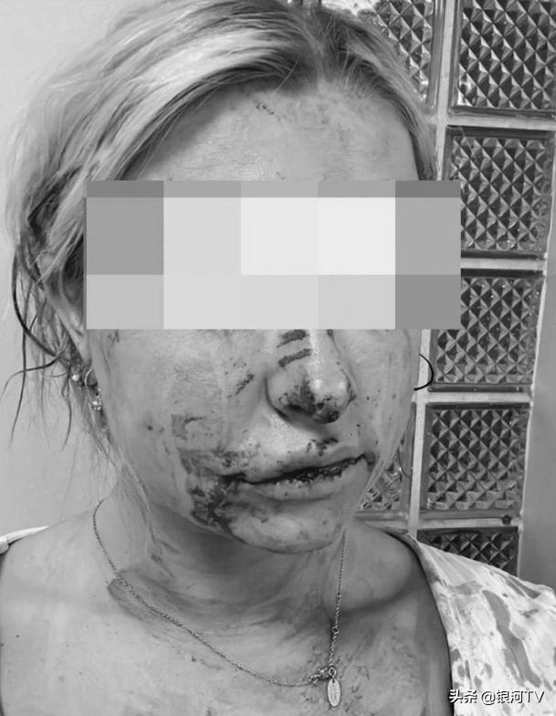 英足坛唐山打人事件！鲁尼爱徒女友被男子暴打，面部毁容（图）