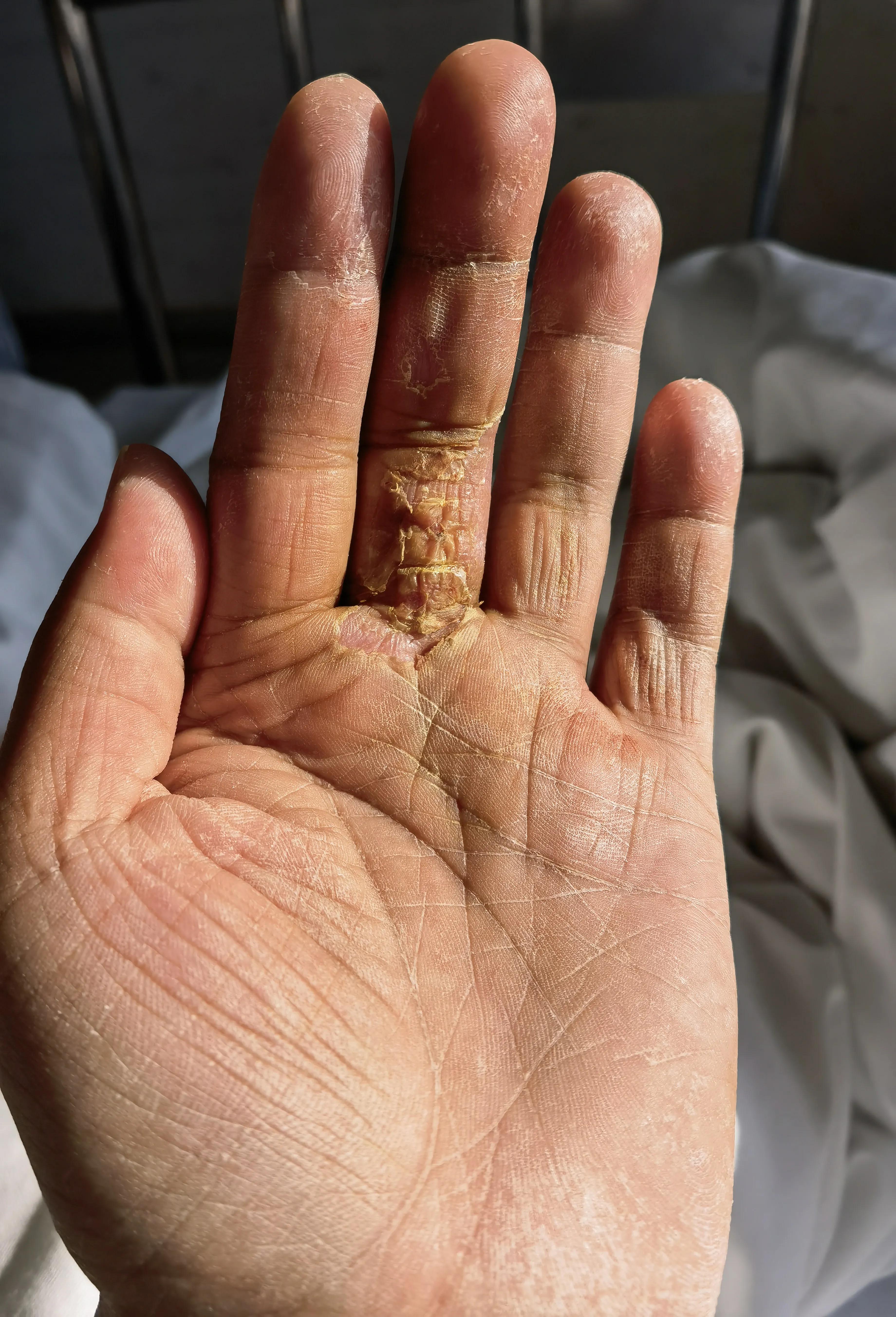 被野猫抓伤破皮要不要打针,被野猫抓伤后打疫苗多少钱