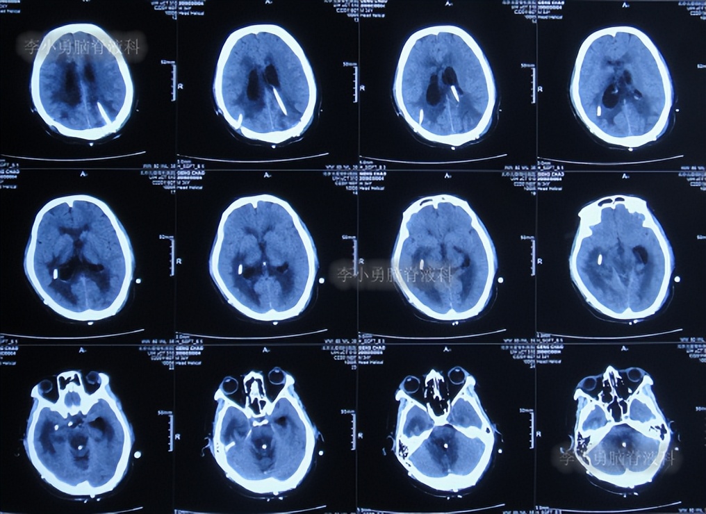 脑积水三脑室造瘘多久能恢复,脑囊虫手术后脑积水