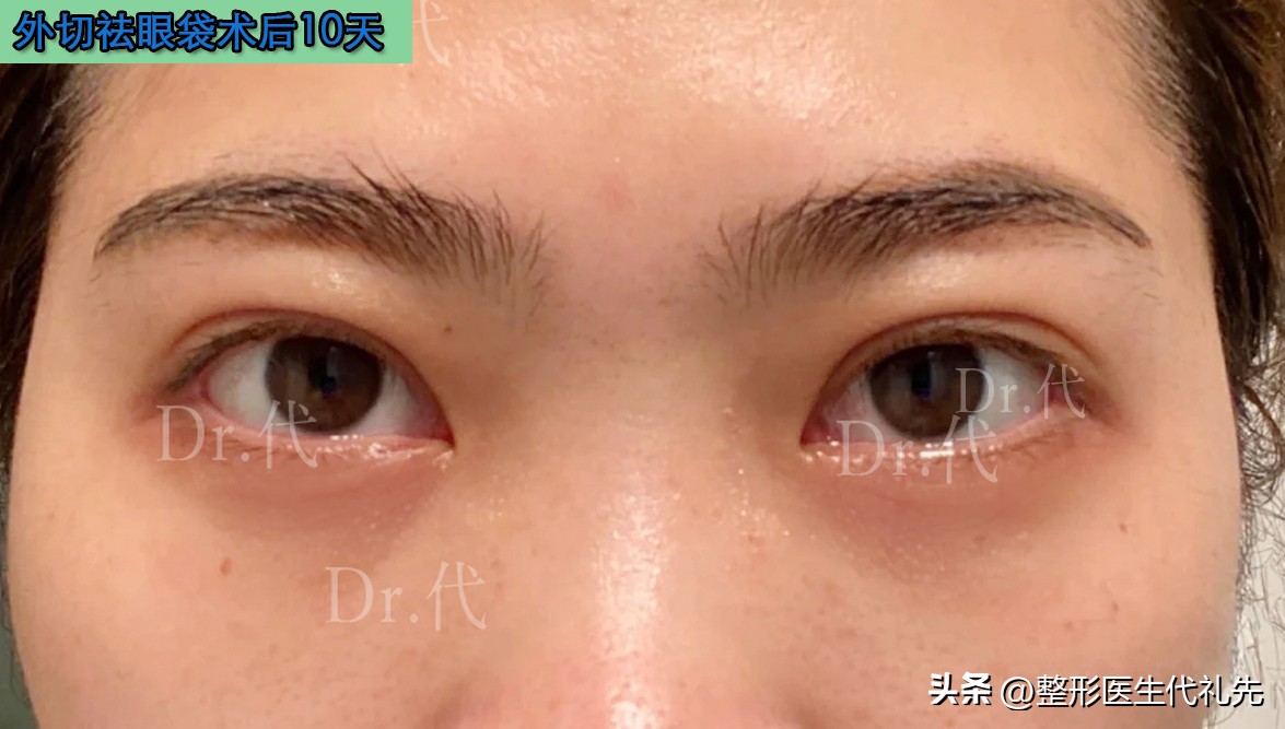 外切眼袋眼睑退缩修复手术对比,50岁外切眼袋手术真实感受