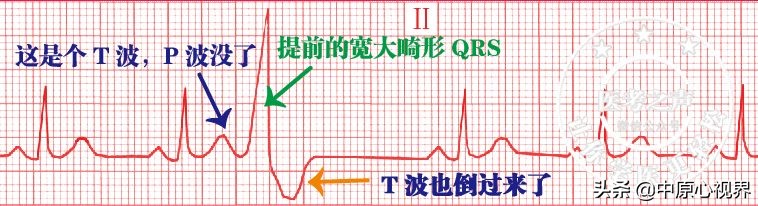 护考几种常见的心电图,常见的心电图图形分析