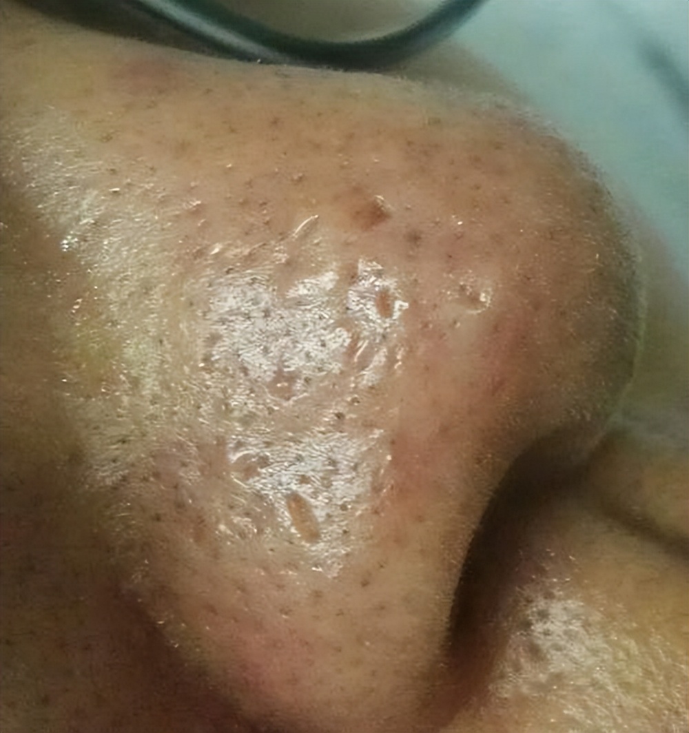 鼻头长黑粉刺怎么回事图片,鼻梁及两侧起了闭口粉刺