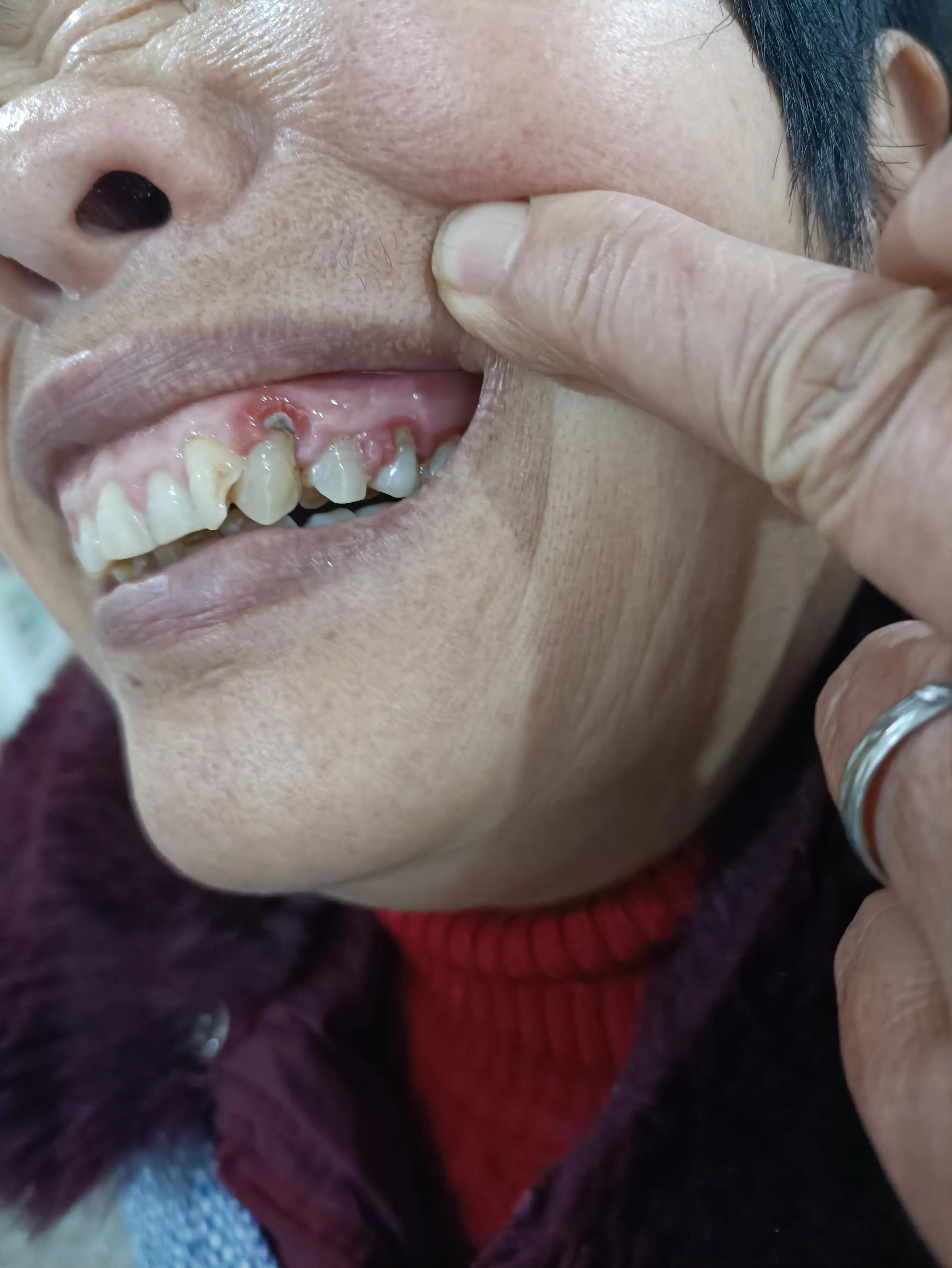 缓解牙痛的非处方药止痛药,牙痛止痛药和消炎药可以一起吃吗