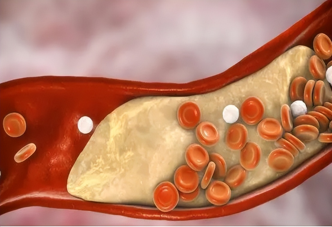 40岁女性叶酸预防心脑血管,预防心脑血管病服叶酸可以吗