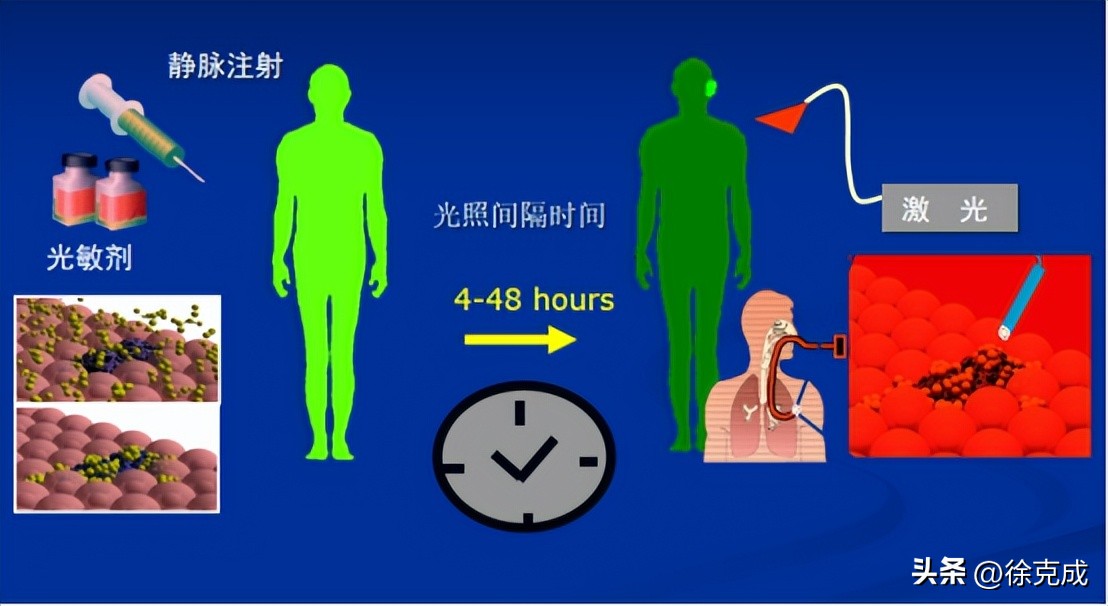 徐克成大讲堂,徐克成谈癌症克星