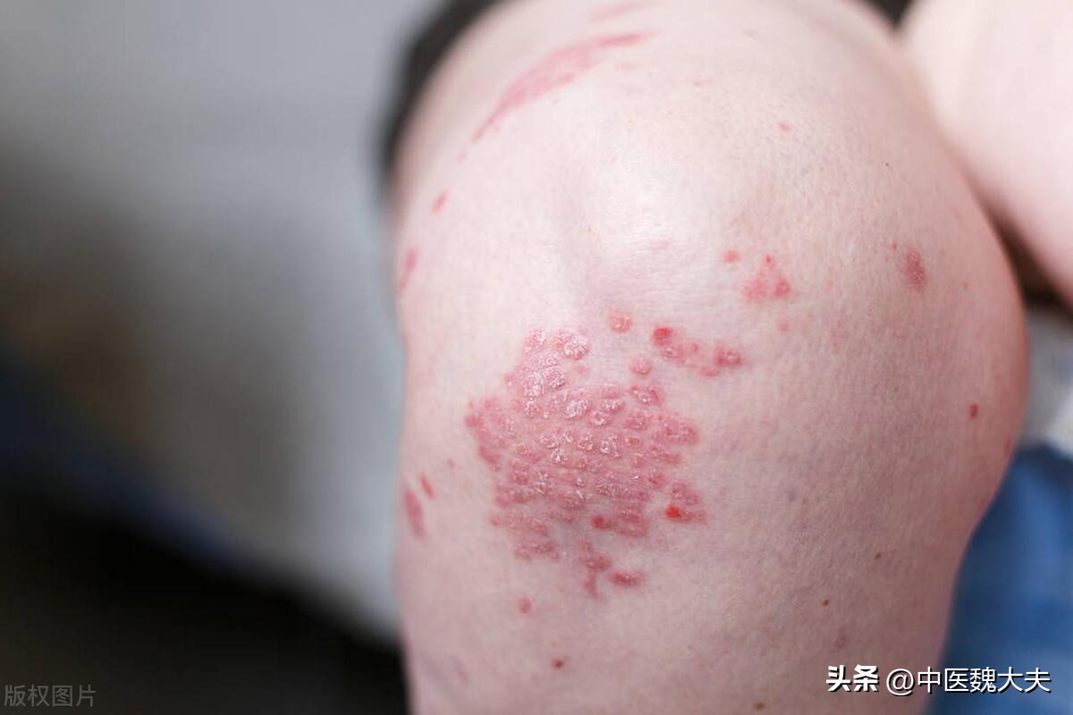 神经性皮炎奇痒难忍用什么药较好,12岁男孩全身奇痒该怎么办