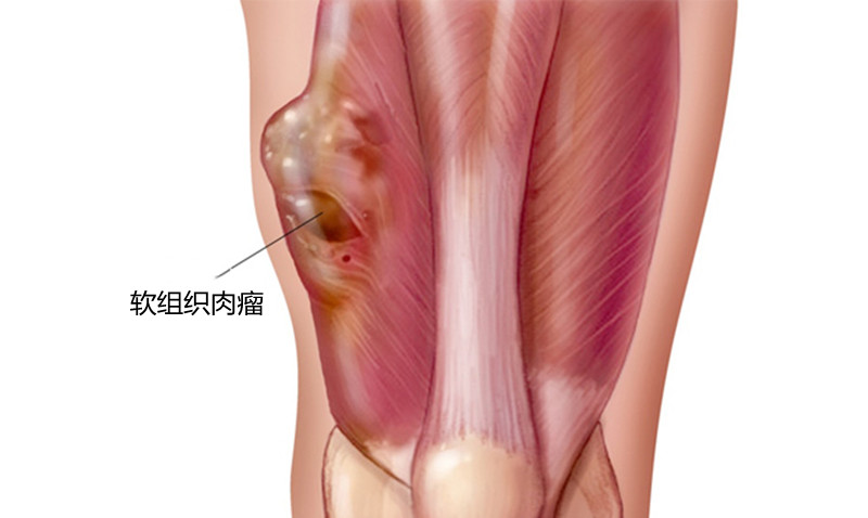 腿上有多处肿块怎么回事,腿上起肿块是怎么回事