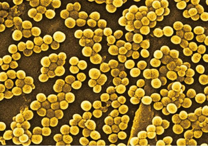 呼吸道感染阿奇霉素和头孢哪个好,呼吸道感染用阿莫西林管用吗