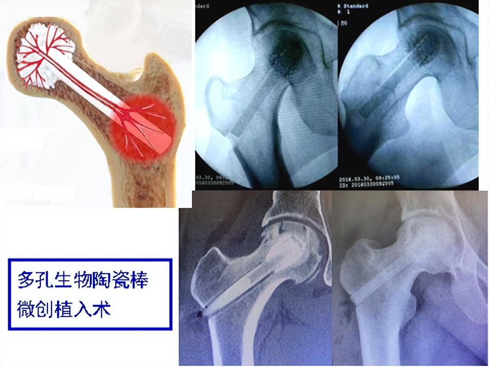 股骨头坏死保髋微创手术成功率,髋部骨头坏死微创手术康复训练