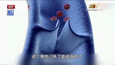 腿酸胀难受怎么缓解静脉曲张,单腿小腿酸胀发麻是静脉曲张吗