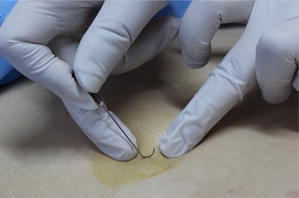 糖尿病胃轻瘫吃的中成药,糖尿病性胃轻瘫中药