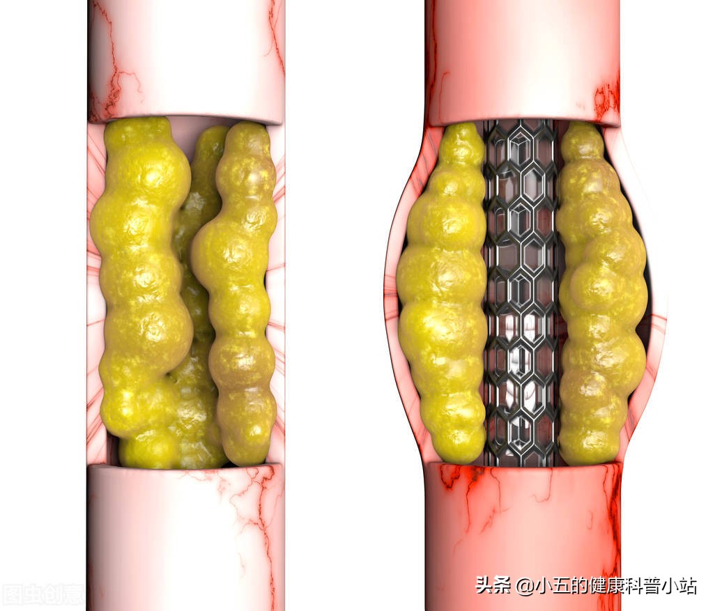 尼可地尔是治疗冠心病的长效药吗,尼可地尔冠心病治疗