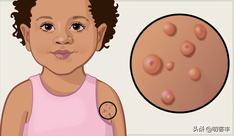 传染性软疣是hpv吗,传染性软疣的快问快答