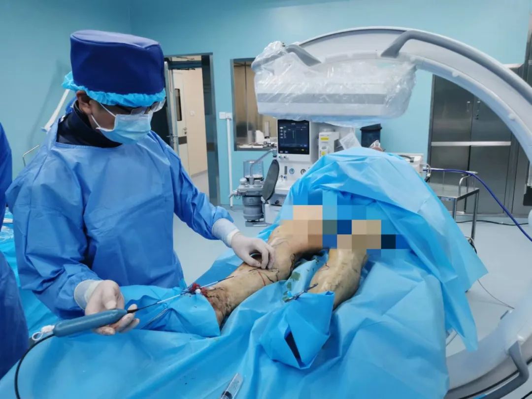 大隐静脉曲张射频消融术视频原理,大隐静脉曲张微波消融术治疗方法