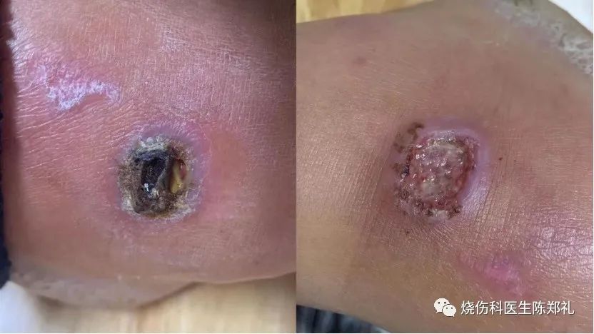 创面外用药物及敷料的使用策略及理论依据