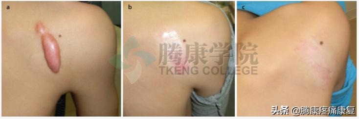 增生性瘢痕和瘢痕疙瘩的鉴别诊断,皮质类固醇贴