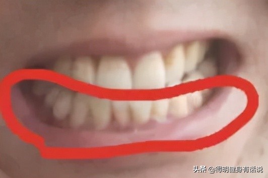 牙齿快暴露牙本质了怎么修复,牙齿已经露出牙本质了怎么修复