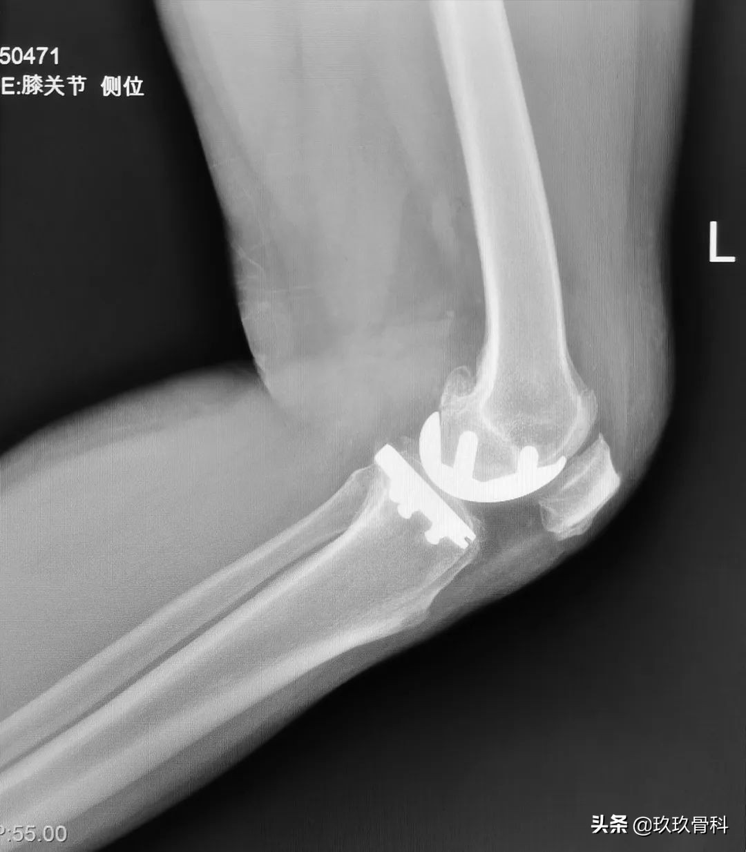 贵阳东方骨科医院膝关节置换,骨科单髁置换手术