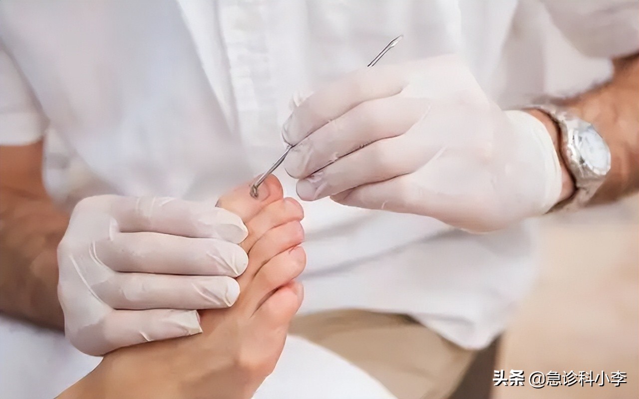 脚趾甲老往肉里长怎么办,甲沟炎脚趾甲往两旁长怎么办