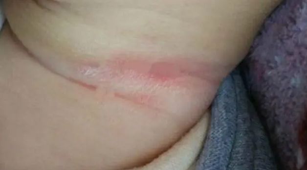 宝宝皮肤淹了可以用炉甘石吗,宝宝皮肤淹了可以抹屁屁乐吗