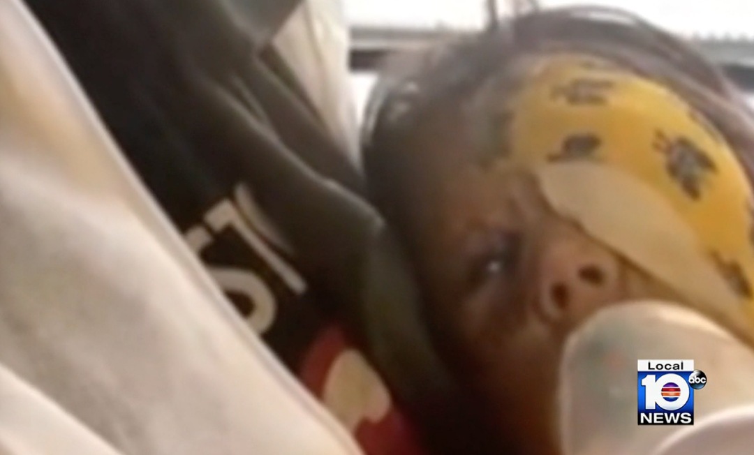 美国小女孩脸带“蝙蝠侠”黑印，治疗两年经过终于恢复肉色！