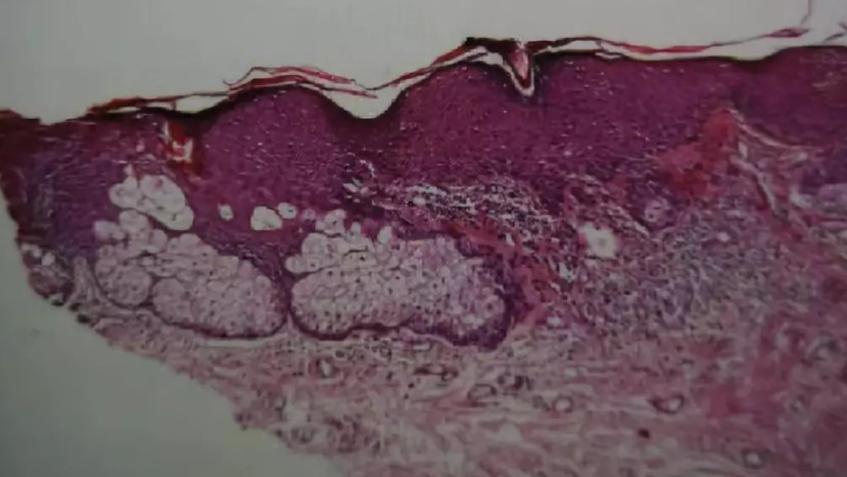 皮肤长的小肉球怎么自己处理,皮肤长出小肉球是什么原因