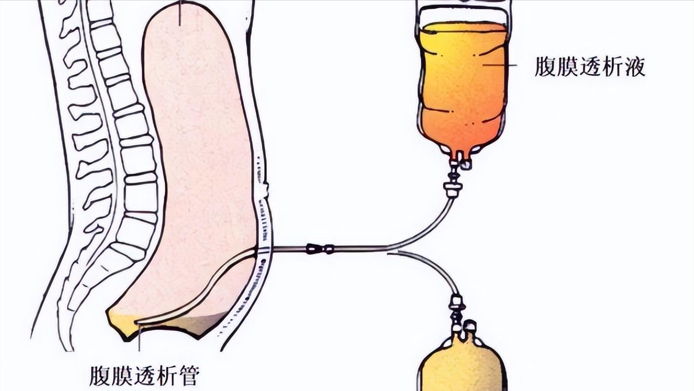 小伙查出尿毒症痛哭,男子查出肾衰竭