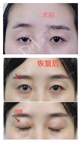 大小眼怎么改善,大小眼严重美睫能改善吗