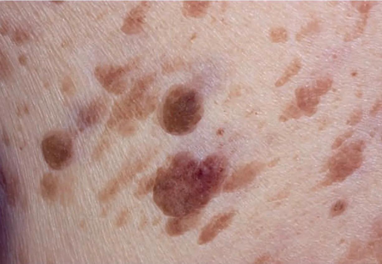 名字吓人却不要太过担心的基底细胞乳头瘤