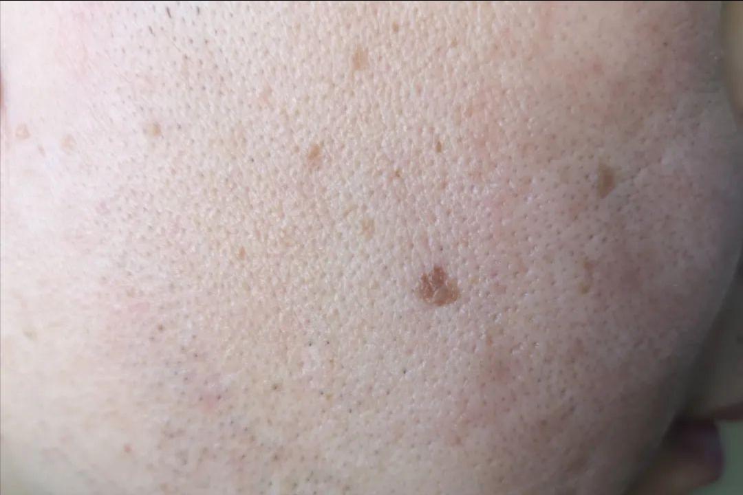 hpv和疣是一种病吗,hpv病毒疣是什么样的