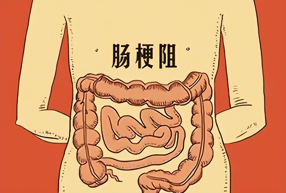 广场舞导致肠梗阻,跳广场舞小肚子疼怎么回事