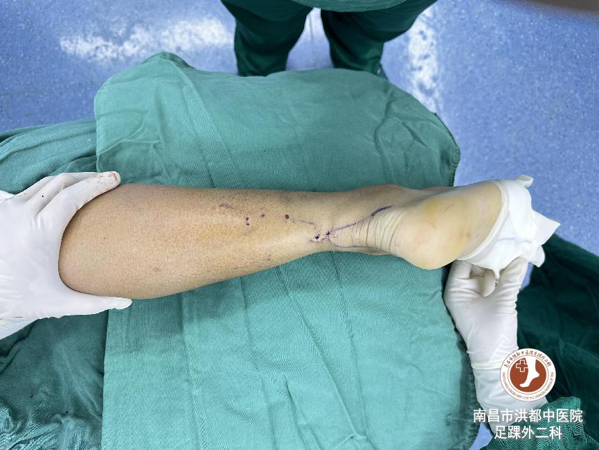 足球运动员韧带断裂修复费用,足球运动员断腿手术