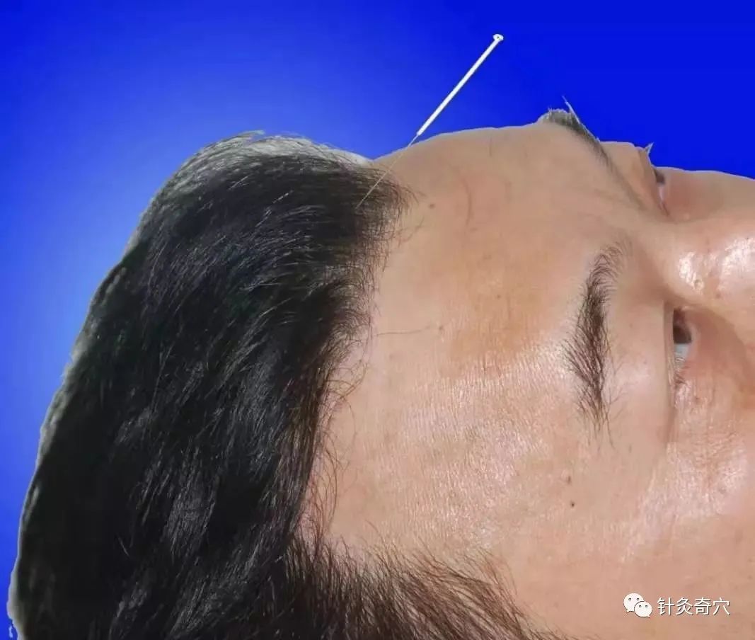 史上最全中医针灸视频教程全集,针灸治疗真实图片大全