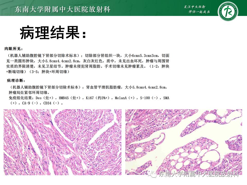 好文分享——《肾血管平滑肌脂肪瘤》