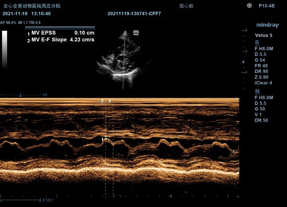 二尖瓣发育不良病例总结