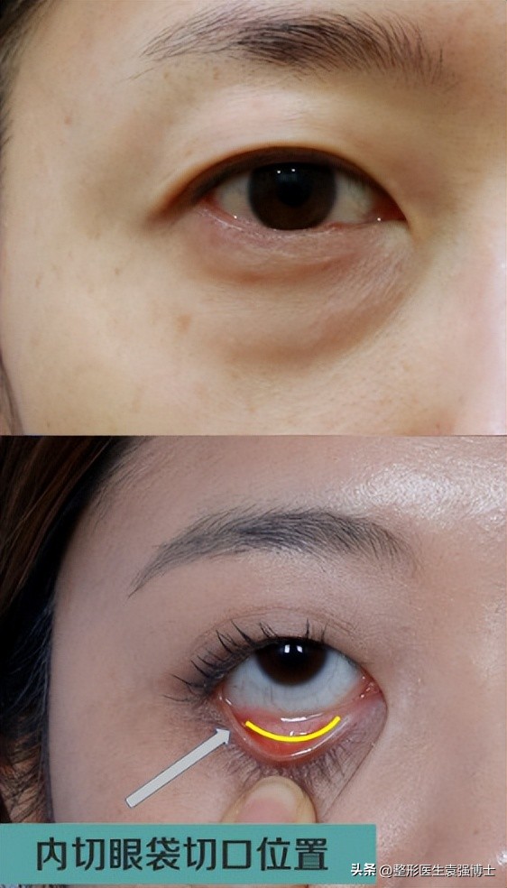 抗衰医美步骤有哪些项目,抗衰的医美项目有哪些